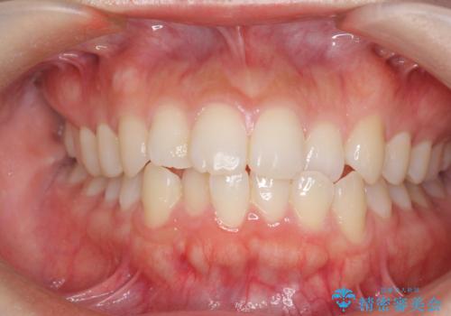 前歯のすれ違い　インビザラインで行うマウスピース矯正の症例 治療前