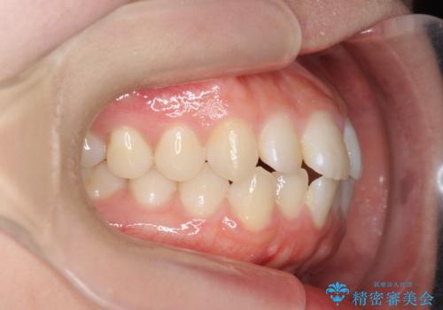 前歯のすれ違い　インビザラインで行うマウスピース矯正の治療前