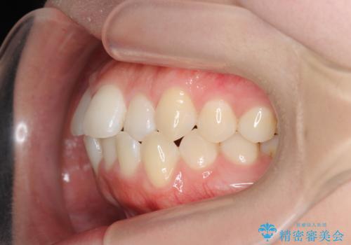 前歯のすれ違い インビザラインで行うマウスピース矯正の治療前