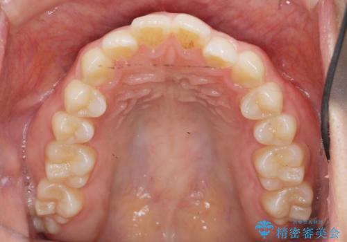 前歯のすれ違い インビザラインで行うマウスピース矯正の治療前