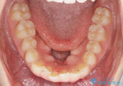 前歯のすれ違い インビザラインで行うマウスピース矯正の治療前