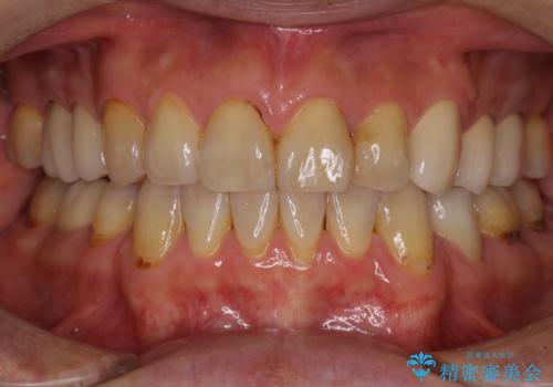 むし歯や銀歯が気になる　後戻りの再矯正治療とむし歯治療の治療中