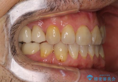 むし歯や銀歯が気になる　後戻りの再矯正治療とむし歯治療の治療中