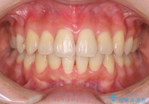 ガタガタの抜歯矯正を裏側ワイヤーを使っての目立たない矯正の症例 治療後