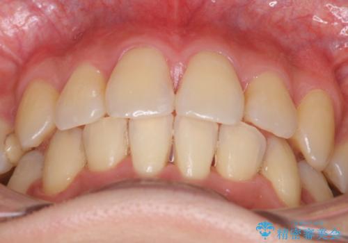 ガタガタの抜歯矯正を裏側ワイヤーを使っての目立たない矯正の治療後