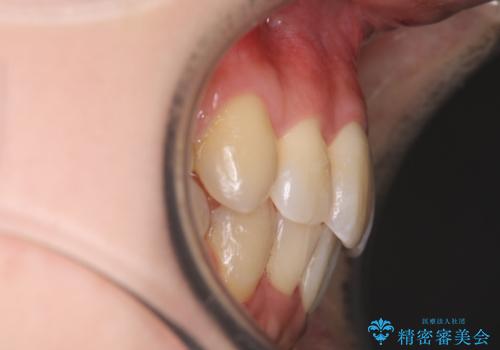 ガタガタの抜歯矯正を裏側ワイヤーを使っての目立たない矯正の治療後