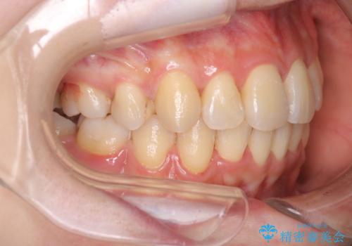 ガタガタの抜歯矯正を裏側ワイヤーを使っての目立たない矯正の治療後