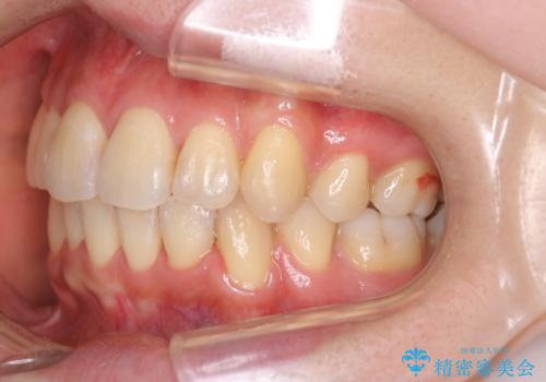 ガタガタの抜歯矯正を裏側ワイヤーを使っての目立たない矯正の治療後