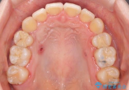 ガタガタの抜歯矯正を裏側ワイヤーを使っての目立たない矯正の治療後