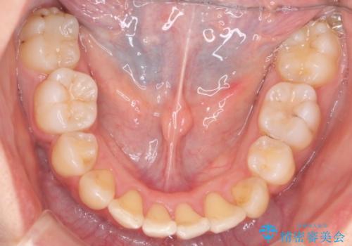 ガタガタの抜歯矯正を裏側ワイヤーを使っての目立たない矯正の治療後