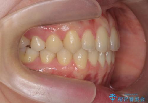 [ マウスピース矯正で前歯の改善 ]  前歯のすきっ歯を治したいの治療後
