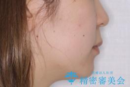 ガタガタの抜歯矯正を裏側ワイヤーを使っての目立たない矯正の治療後(顔貌)