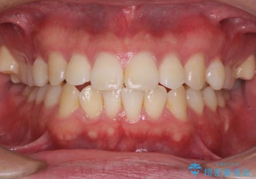 インビザラインで奥歯の咬み合わせと前歯のデコボコを改善の症例 治療前