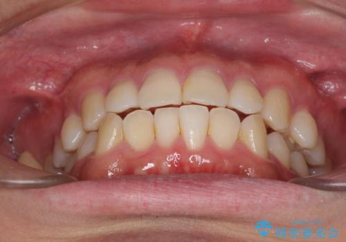 インビザラインで奥歯の咬み合わせと前歯のデコボコを改善の治療前