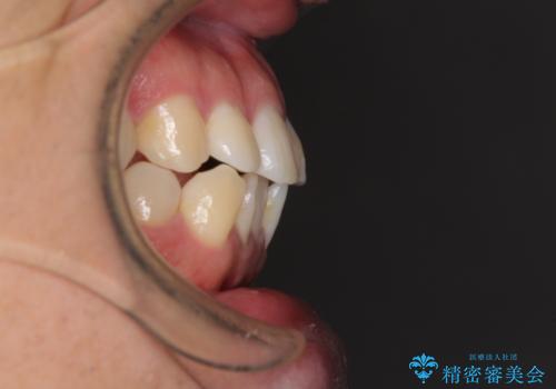 インビザラインで奥歯の咬み合わせと前歯のデコボコを改善の治療前