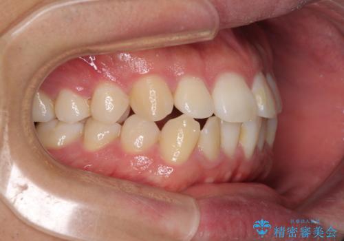 インビザラインで奥歯の咬み合わせと前歯のデコボコを改善の治療前