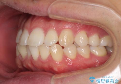インビザラインで奥歯の咬み合わせと前歯のデコボコを改善の治療前