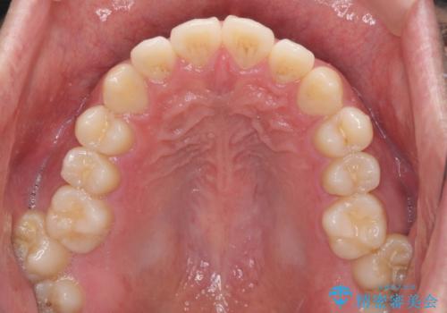 インビザラインで奥歯の咬み合わせと前歯のデコボコを改善の治療前