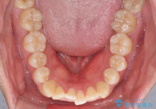 インビザラインで奥歯の咬み合わせと前歯のデコボコを改善の治療前