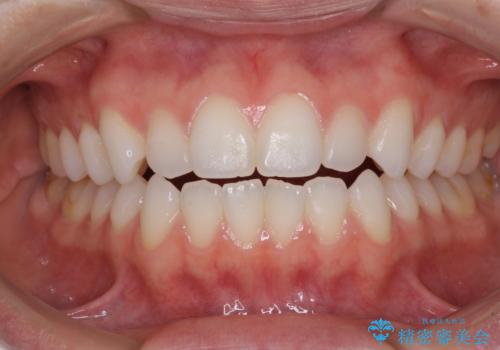 上下前歯が接触しない　オープンバイトをインビザラインで改善の症例 治療前