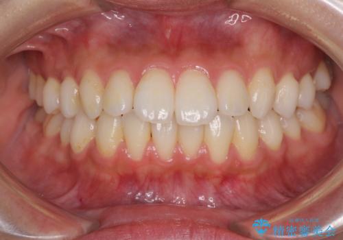 インビザラインで口を閉じやすくの症例 治療前