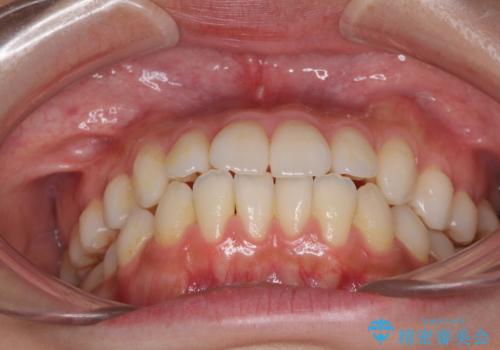 インビザラインで口を閉じやすくの治療前