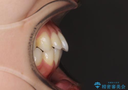 インビザラインで口を閉じやすくの治療前
