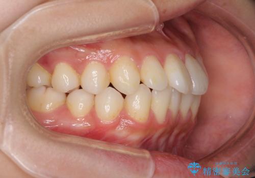 インビザラインで口を閉じやすくの治療前