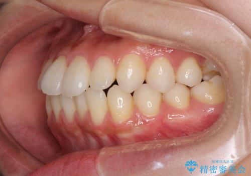 インビザラインで口を閉じやすくの治療前