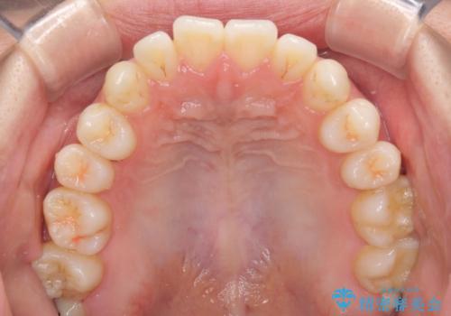 インビザラインで口を閉じやすくの治療前