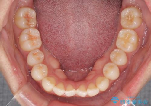 インビザラインで口を閉じやすくの治療前