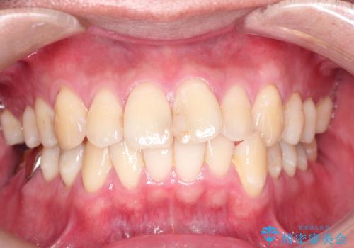 全体的ながたつきをインビザラインで改善の症例 治療前