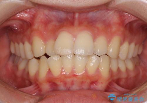 短期間で口元の突出感を改善　ワイヤー装置での抜歯矯正の症例 治療前