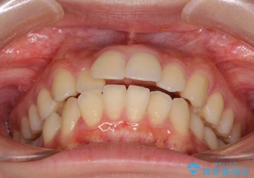 短期間で口元の突出感を改善 ワイヤー装置での抜歯矯正の治療前