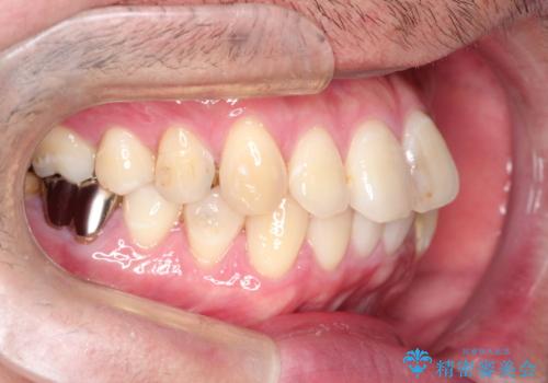 全体的ながたつきをインビザラインで改善の治療前