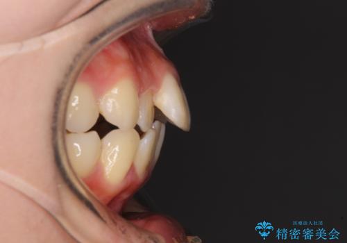 短期間で口元の突出感を改善 ワイヤー装置での抜歯矯正の治療前