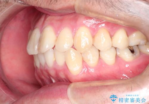 全体的ながたつきをインビザラインで改善の治療前