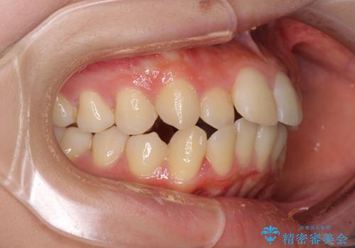 短期間で口元の突出感を改善　ワイヤー装置での抜歯矯正の治療前