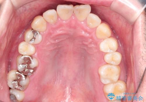 全体的ながたつきをインビザラインで改善の治療前