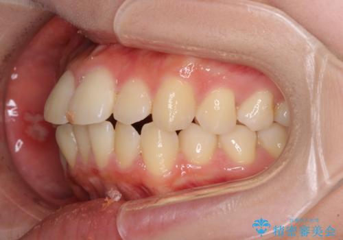 短期間で口元の突出感を改善 ワイヤー装置での抜歯矯正の治療前