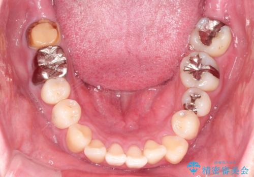 全体的ながたつきをインビザラインで改善の治療前