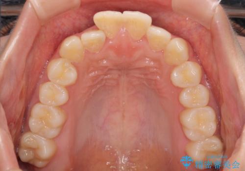 短期間で口元の突出感を改善 ワイヤー装置での抜歯矯正の治療前