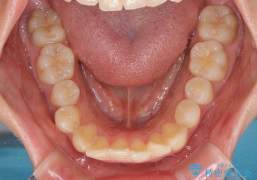 短期間で口元の突出感を改善 ワイヤー装置での抜歯矯正の治療前