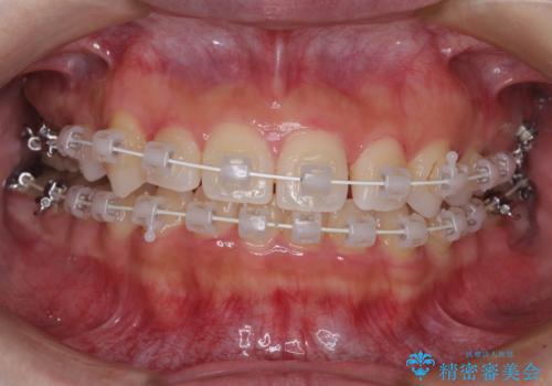 八重歯を改善 目立たないワイヤー装置での矯正治療の治療中