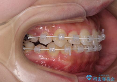 八重歯を改善 目立たないワイヤー装置での矯正治療の治療中
