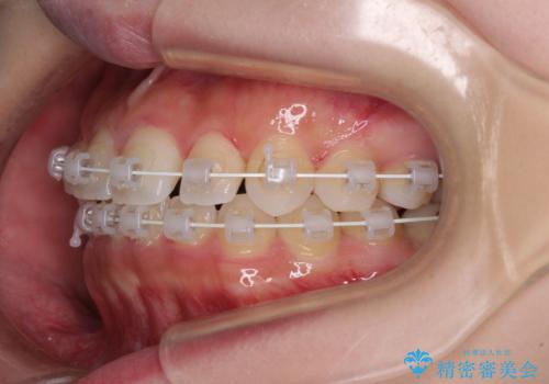 八重歯を改善 目立たないワイヤー装置での矯正治療の治療中