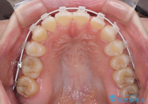 八重歯を改善　目立たないワイヤー装置での矯正治療の治療中
