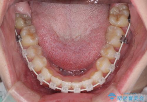 八重歯を改善 目立たないワイヤー装置での矯正治療の治療中