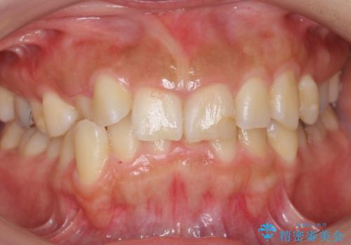 前歯のがたつき　ガミースマイルの改善の症例 治療前