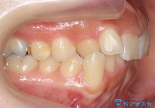 前歯のがたつき　ガミースマイルの改善の治療前